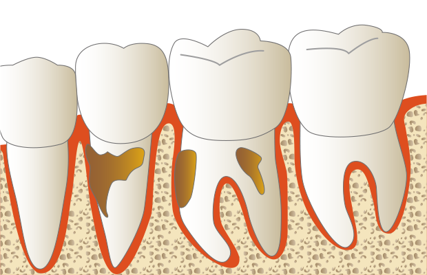 歯肉の深いところに歯石が付いている部分があります。