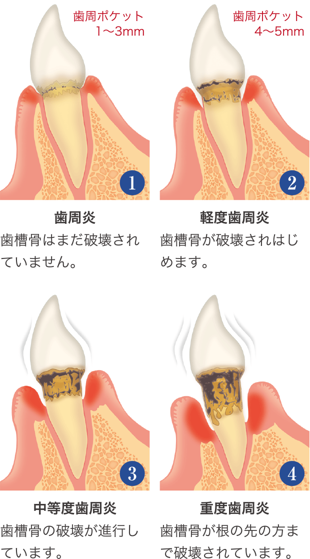 歯周炎 歯槽骨はまだ破壊されていません。/軽度歯周炎 歯槽骨が破壊されはじめます。/中等度歯周炎 歯槽骨の破壊が進行しています。/重度歯周炎 歯槽骨が根の先の方まで破壊されています。
