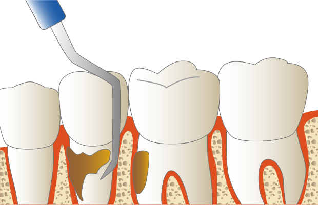 歯石を徹底的に取り除き、歯根の表面をきれいに清掃します。