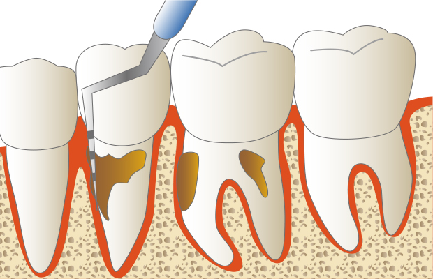 壁性骨欠損、深い歯周ポケット、セメント質と歯根膜、歯槽骨の欠損