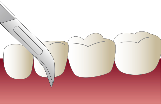 2.歯周外科手術