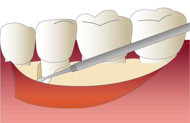 3.歯周外科手術