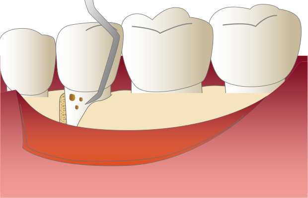 4.歯周外科 手術