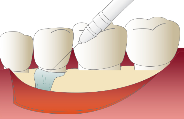 5.歯周外科手術