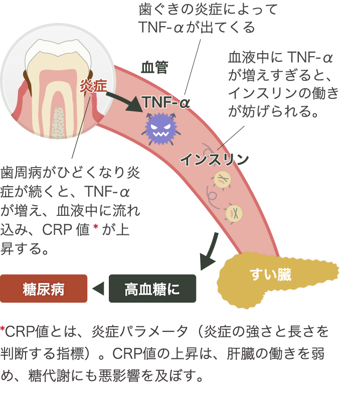 歯周病と“糖尿病”の関係。