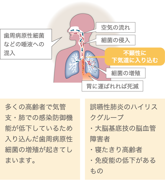 歯周病と“誤嚥性肺炎”の関係